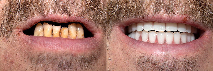 Пример работы скуловая имплантация фото до и после